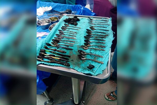¡Se comió 20 cucharas, cuatro tenedores, cepillos de dientes y hasta joyas!